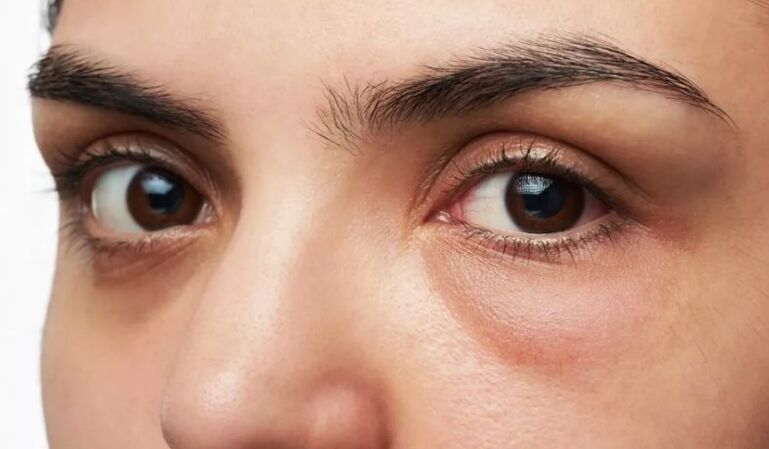 Sacs sous les yeux, gonflement