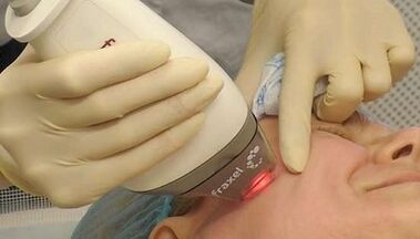 Comment se déroule le resurfaçage fractionné de la peau 