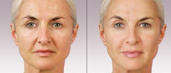 Plastique de contour