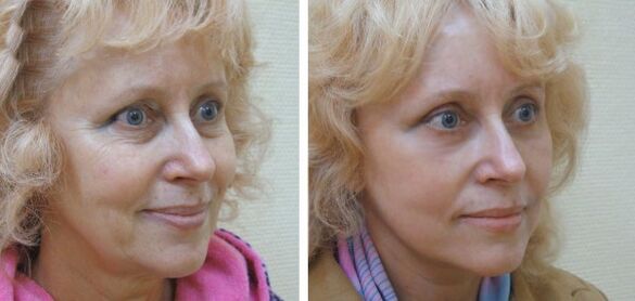 Femme avant et après rajeunissement de la peau du visage au plasma. 