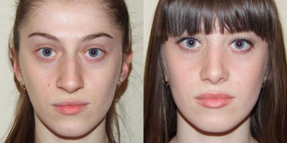 Fille avant et après rajeunissement de la peau du visage avec du plasma. 