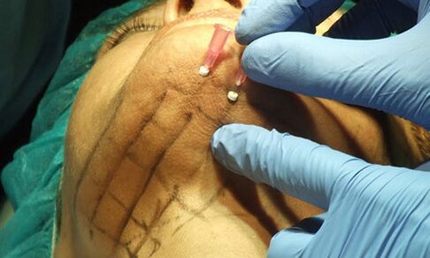 Le lifting par fil, une technique mini-invasive pour le rajeunissement de la peau du visage